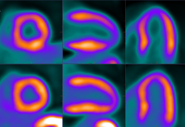 PET cardiac scan