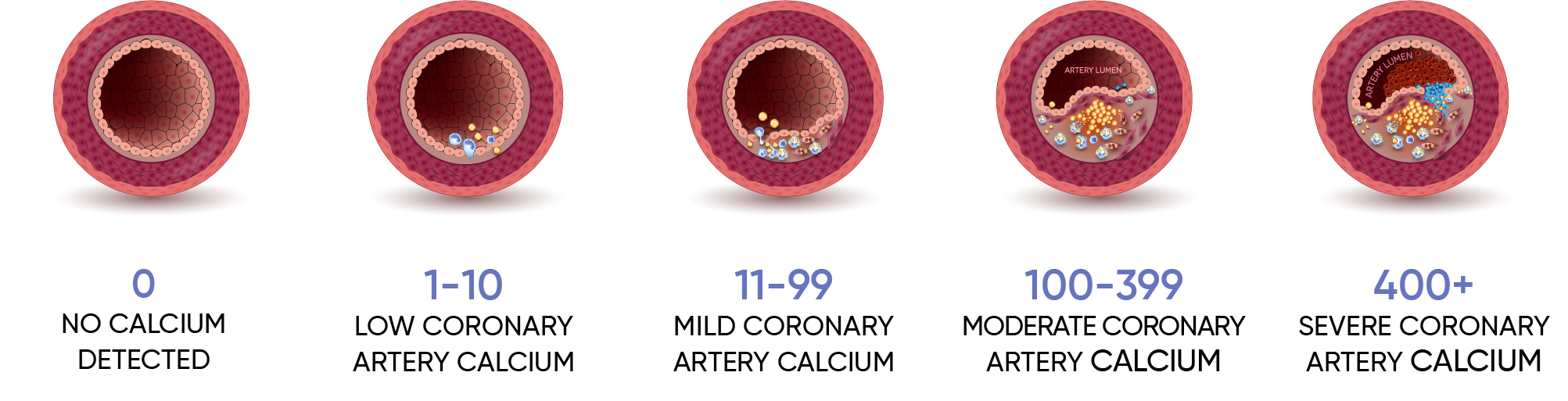 coronary calcium score explained