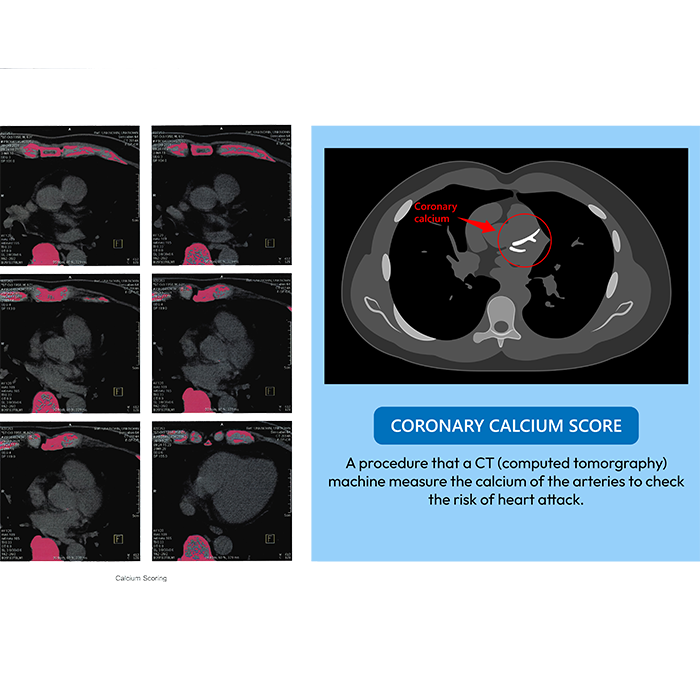 coronary calcium score illustration and description