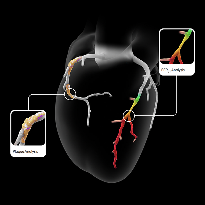 coronary ct angiogram plaque and ffr-ct analysis