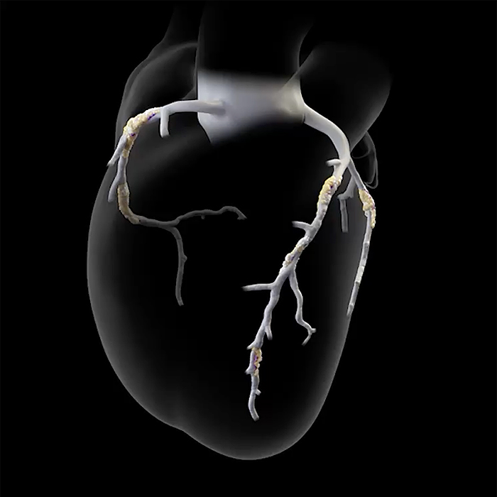 CardioNow CCTA scan with plaque analysis