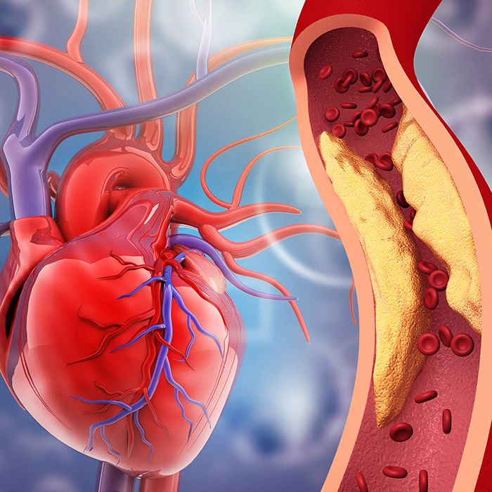 ldl cholesterol clogged artery blockage