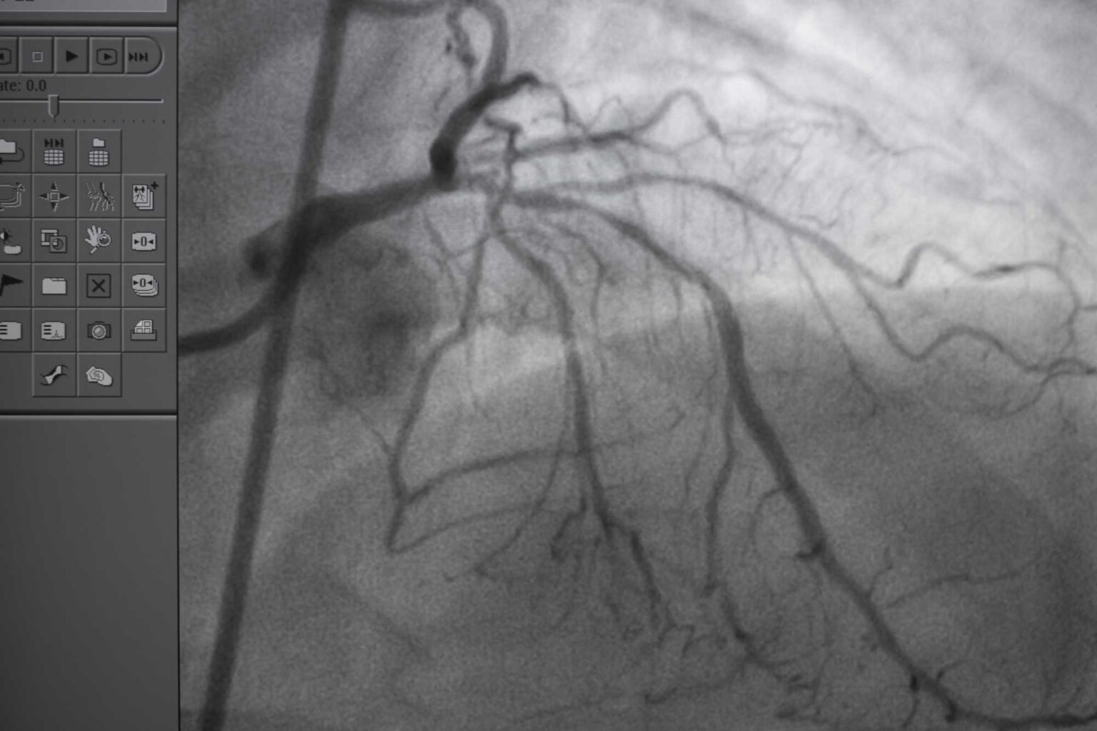 Evaluate Your Heart Health with a Coronary CT Angiogram