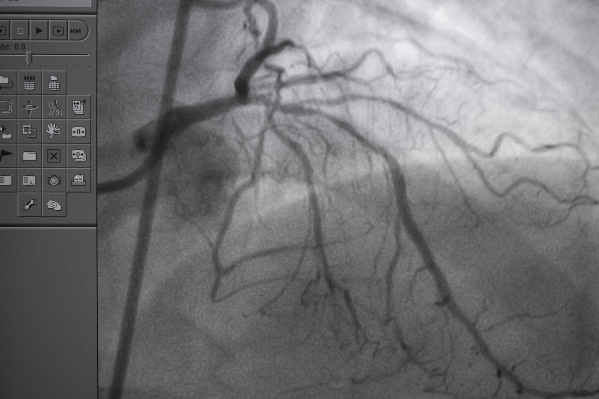 Evaluate Your Heart Health with a Coronary CT Angiogram