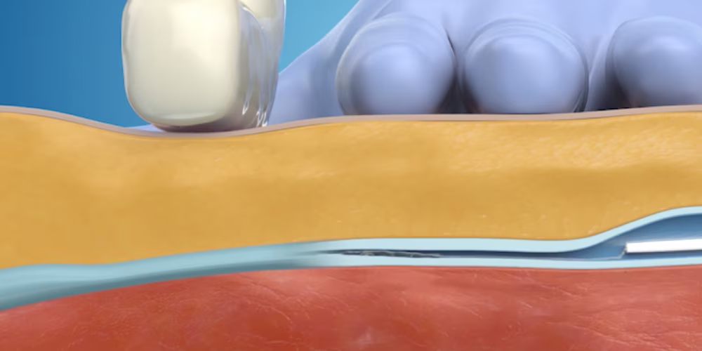 Step-3-venaseal-light-external-pressure-applied