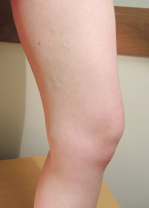 Patient leg after VenaSeal procedure