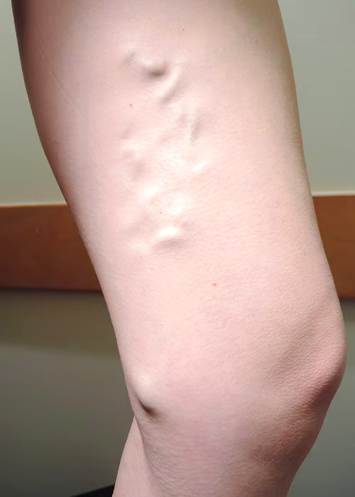 Patient leg before VenaSeal procedure