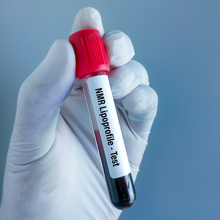 Blood sample for NMR Lipoprofile test.