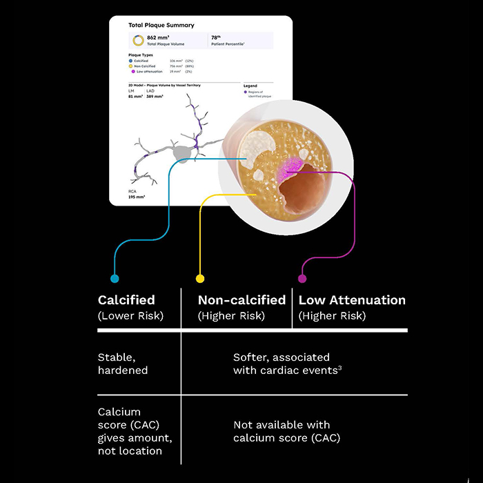 CCTA plaque analysis - calcified and non-calcified plaque