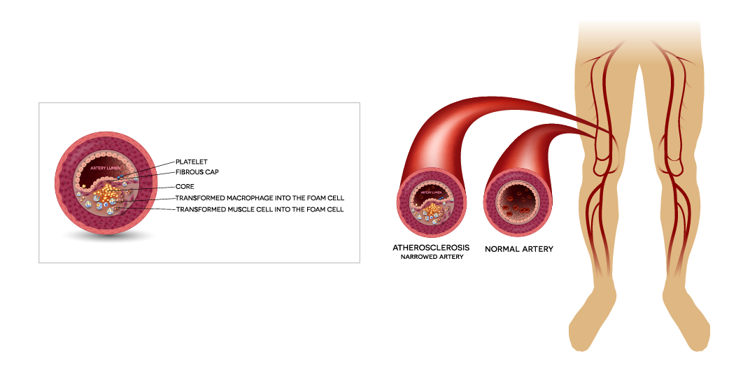 What is peripheral artery disease (PAD) illustration